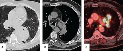 Case Report: A rare case of familial lung cancer requiring pneumonectomy in three male siblings